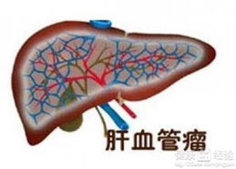 肝血管瘤液化的症状