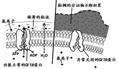 囊性纤维化病(新生儿囊性纤维化)