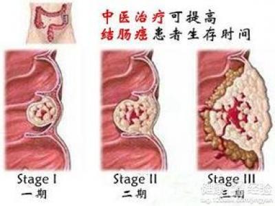 结肠癌遗传现象你知多少