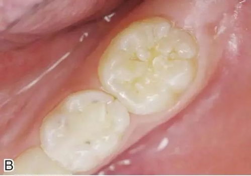 龋齿是什么意思 孩子已经长龋齿了，应怎么护理呢？ 