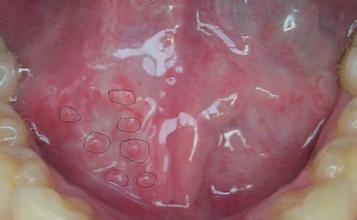 hpv口腔感染的症状图片图片