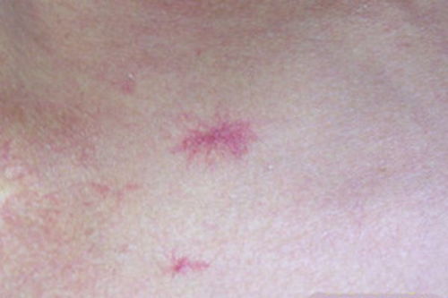 皮肤突然长红痣,就是肝病的前兆 还与什么有关 很多人或搞错了