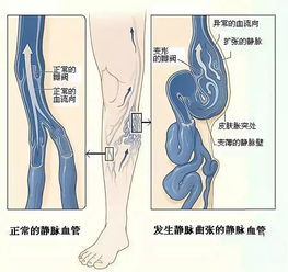 静脉曲张老不好,请到石屏中医找专家