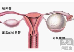 卵巢囊肿微创手术休息几天 术后注意事项解析