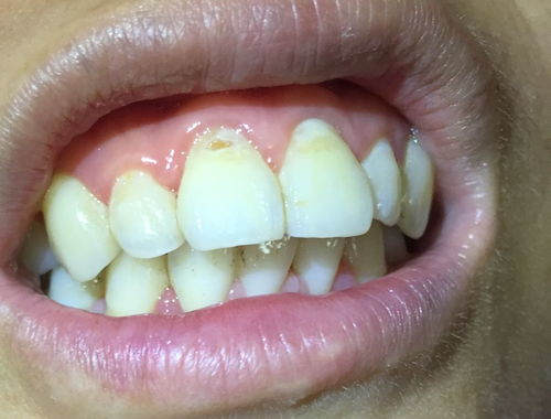 门牙多年前撞了牙面有裂痕,牙根很脆弱,最近才发现不知何时门牙根有残破一个洞,这个怎么办 会断掉吗 