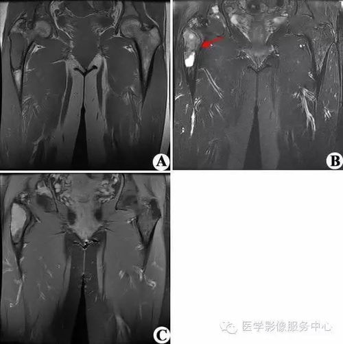 股骨上段骨纤维异常增殖症手术后需注意哪些问题？