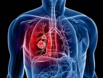 为什么医生说肺部有阴影没事 或说不用管肺部结节