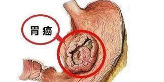 胃癌是十分常见的消化道恶性肿瘤之一,它会传染吗 为什么