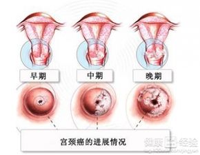 是否患宫颈癌需要做哪些检查