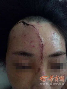 女子玩漂流出意外遭毁容 面部伤口达20厘米 