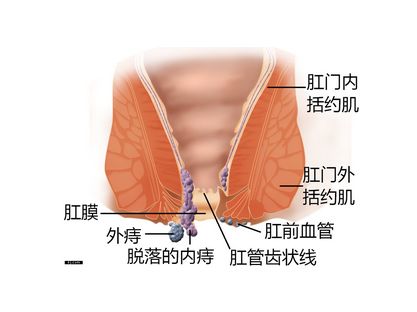 痔疮可以自愈吗 有哪些治疗手段 医生告诉你答案