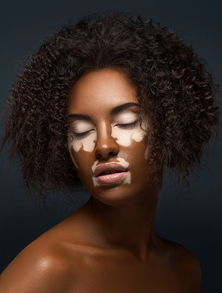 Vitiligo 人像彩妆