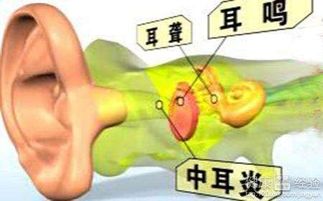 耳内堵塞 闷胀 耳鸣 听力下降 这是怎么回事