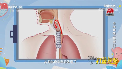 睡觉憋醒 呼吸困难,竟然是胃食管反流病,饮食要注意 