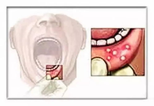 口腔溃疡怎么读 口腔溃疡的读音
