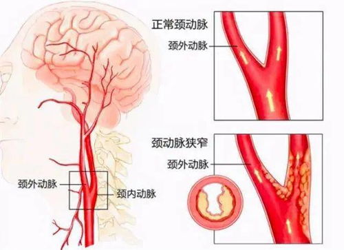 七旬老人一觉醒来莫名头晕乏力,原来罪魁祸首是颈动脉狭窄,医生用这项技术帮助了他