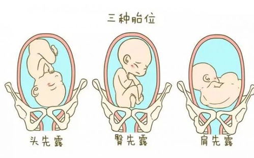 腹中宝宝一直处于臀位状态,想知道臀位宝宝生出来腿会有毛病吗