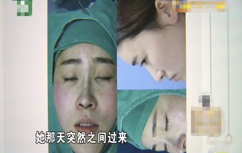 杭州女子做隆鼻手术后流产,鼻子歪斜不对称,耳朵一天还比一天大