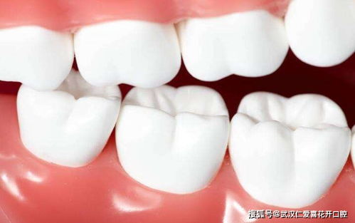 得了牙周炎 不要担忧 牙齿贴面美学修复 口腔医生李明