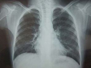 权威解释什么是慢阻肺