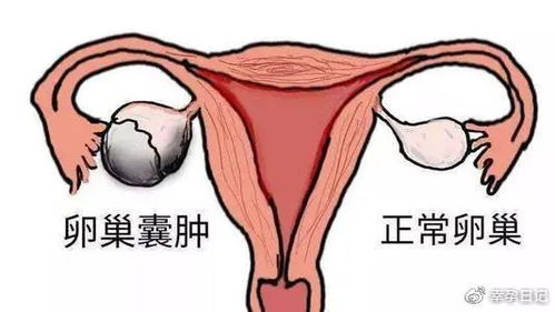 有卵巢囊肿可以移植胚胎吗 移植后囊肿会继续增大吗