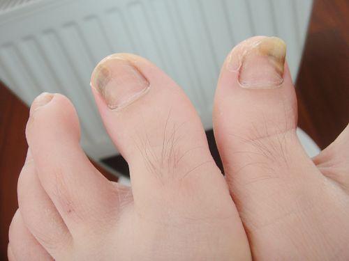 为什么我的脚趾大拇指的指甲缝中总是有恶臭味 