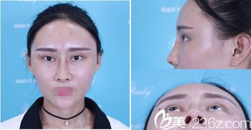 看芜湖瑞丽王俞明自体脂肪填充全脸 鼻综合真人案例术后效果怎么样
