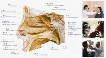 鼻腔囊肿治得好吗 广州协佳耳鼻喉 