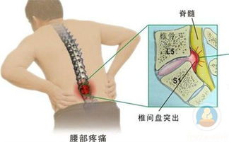 腰椎间盘突出有哪几个时期 外贴可以治好吗