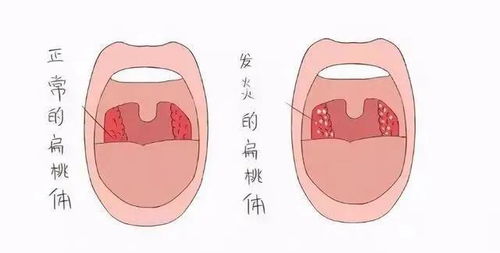 扁桃体发炎 扁桃体肥大怎么办 很简单,中医烙法来了