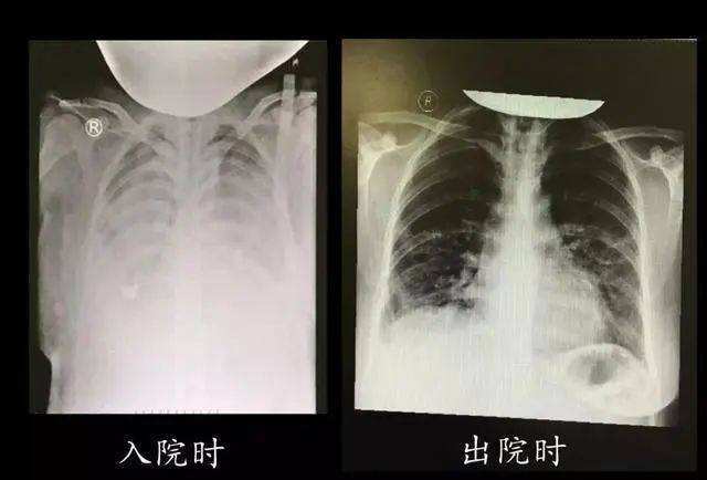 新型冠状病毒发现经过 症状,生命体征,武汉市金银滩医院