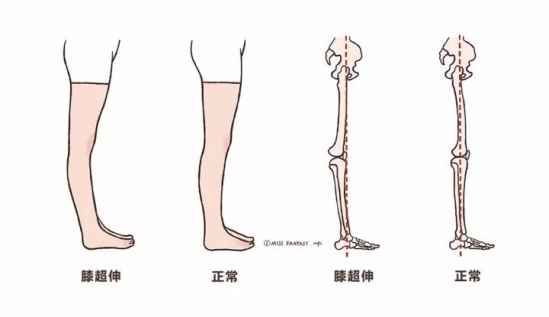 膝盖超伸怎么矫正 