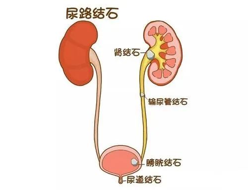 半小时左右完成直径3厘米的肾结石手术 这场直播让你重新认识泌尿结石疾病