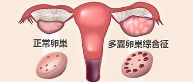 珠海妇幼健康知识云讲堂：如何判断是否患有多囊卵巢综合征？