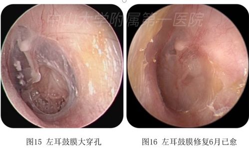 听力下降 耳痛难耐 耳朵鼓膜穿孔怎么办 专家来支招