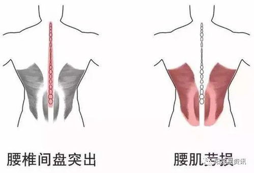 怎样才算是腰肌劳损 又该如何预防调理