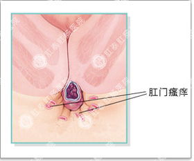 肛门瘙痒是什么原因？为什么会肛门瘙痒,是什么原因啊