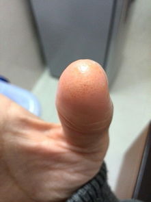 右手拇指食指一开始长透明水泡,慢慢变黄,皮质变硬,裂开脱皮,循环好久了是怎么回事 