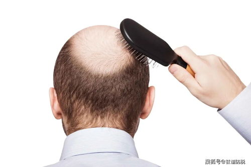 脱发的原因有哪些 雄脱发的原因是什么情况 雄性激素脱发是什么原因