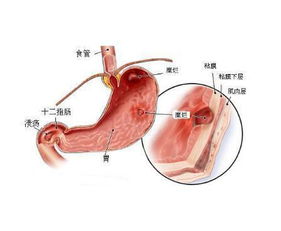 糜烂性胃炎能喝茶叶水吗(糜烂性胃炎可以喝茶吗)