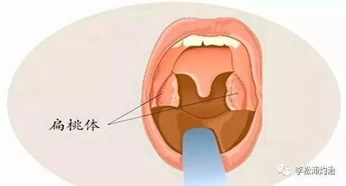 扁桃体肥大发病原因都有什么 扁桃体肥大是什么原因引起的