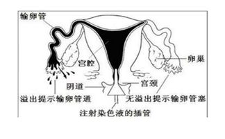 输卵管造影是什么 疼吗 有什么副作用 生男生女帮 