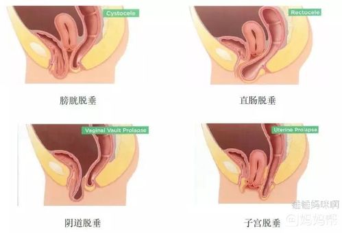 不要把阴道膨出当便秘来治