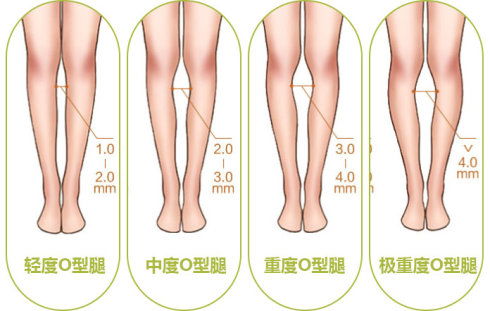 O型腿和正常腿图片 信息阅读欣赏 信息村 K0w0m Com