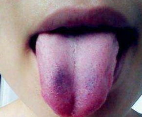 血糖高不高,看看舌头也能知道 若舌头有这3个表现,最好去查下