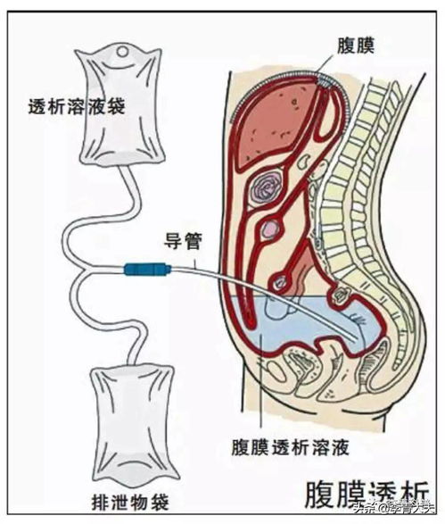 热播剧 乔家的儿女 关于尿毒症的三大硬伤