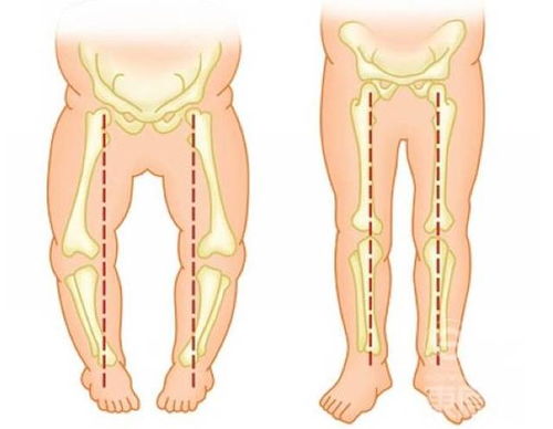 婴儿o型腿判断标准图 搜狗图片搜索