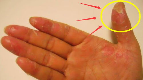手指 脱皮 是什么原因 可能是身体发出的 求救 信号,最好别大意 