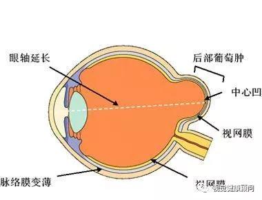 家长必读 孩子近视不可怕,可怕的是近视并发症