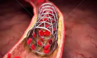 放支架有没有滥用 哪些情况的冠心病不适合放支架